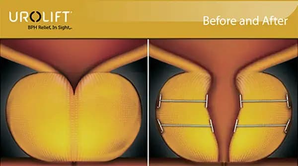 What is UroLift®?
