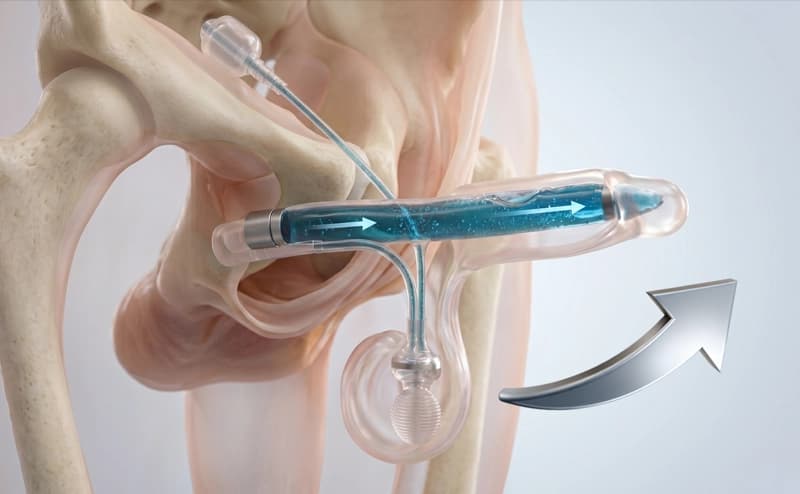 PENILE
IMPLANT